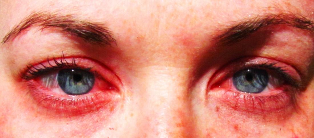 allergic reaction on face pollen