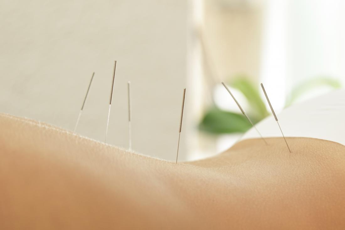 Acupuncture needles