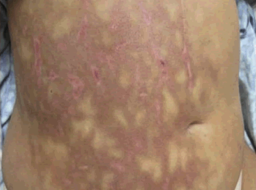 Acute pancreatitis causing mottled skin or Livedo reticularis on abdomen.