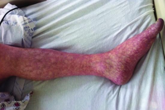 Livedo reticularis commonly affects the skin of the legs.