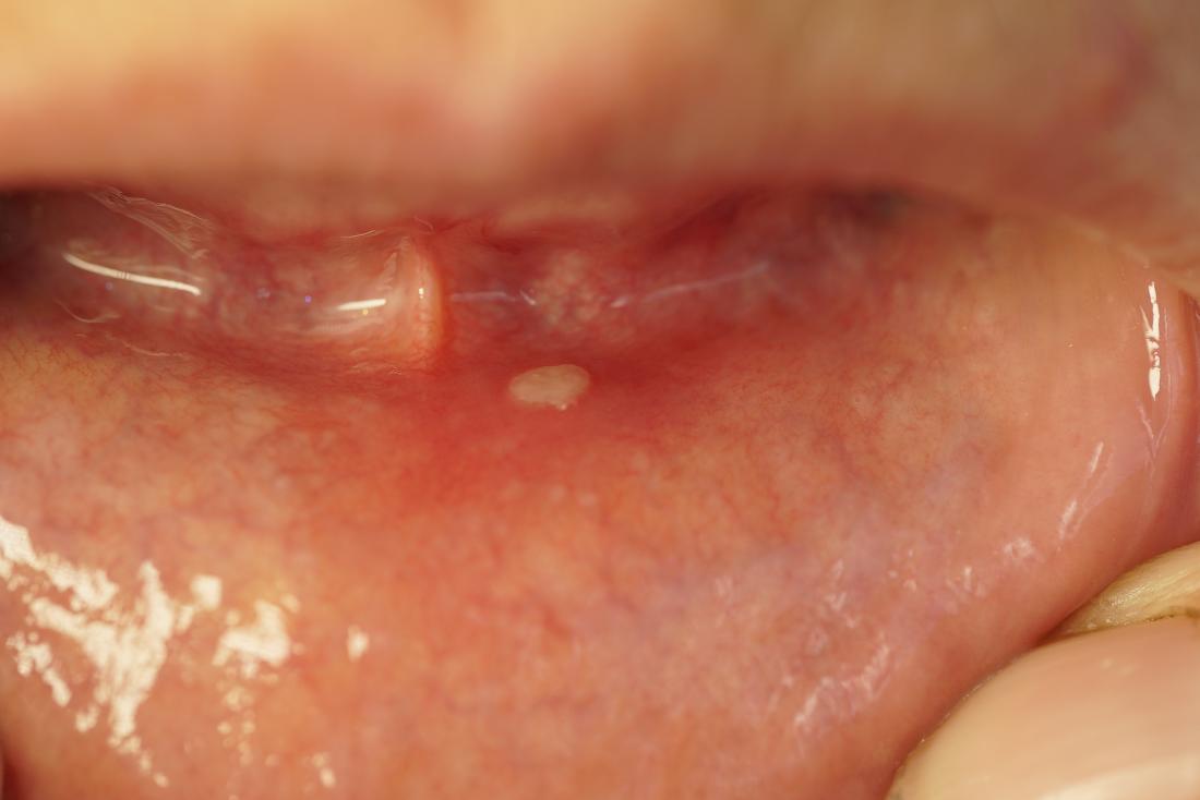 White spots and sores on gums: Causes, treatment, and symptoms