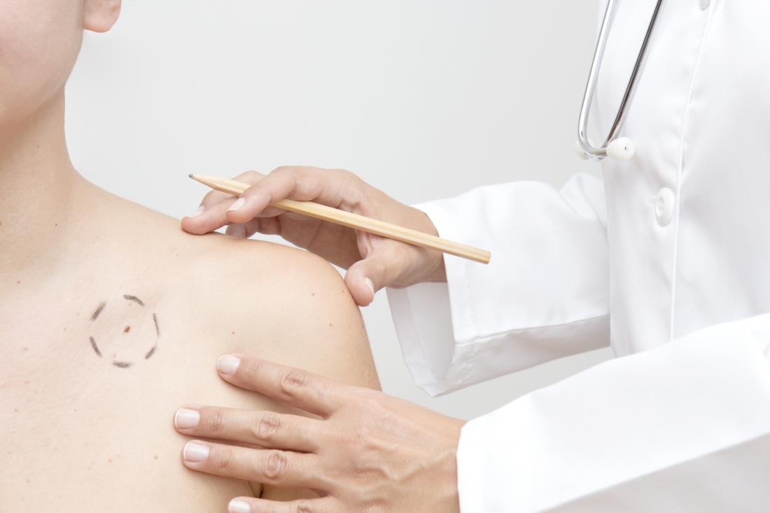 doctor examining melanoma