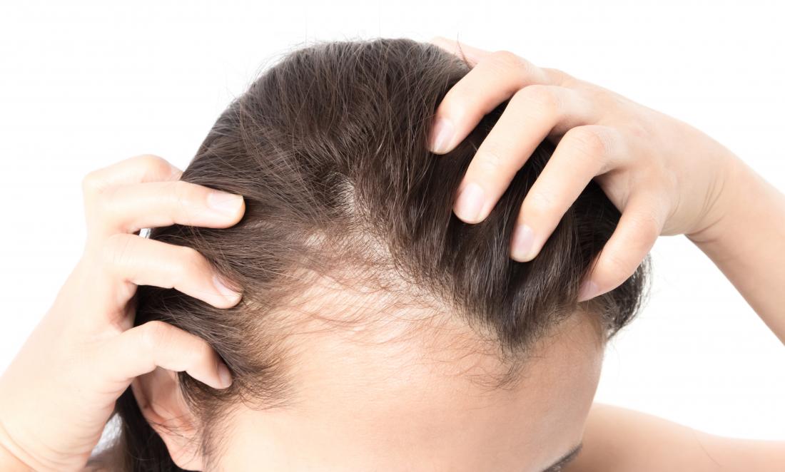 Hair Loss In Women – Causes and Cures