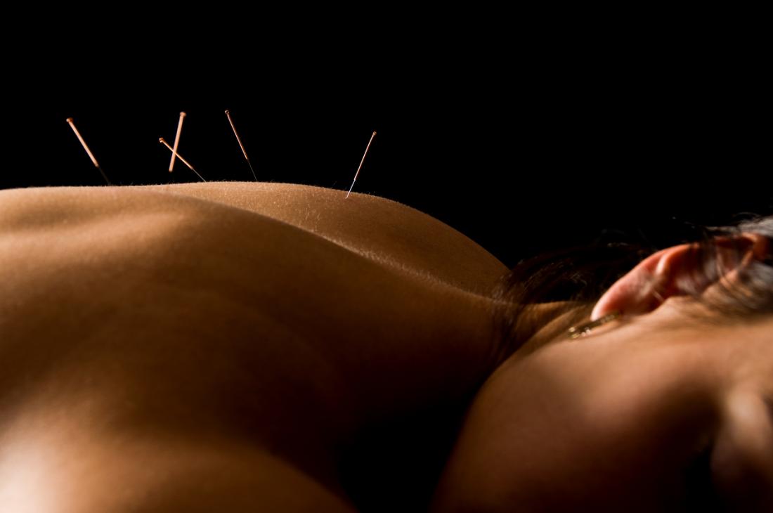 woman undergoing acupuncture treatment