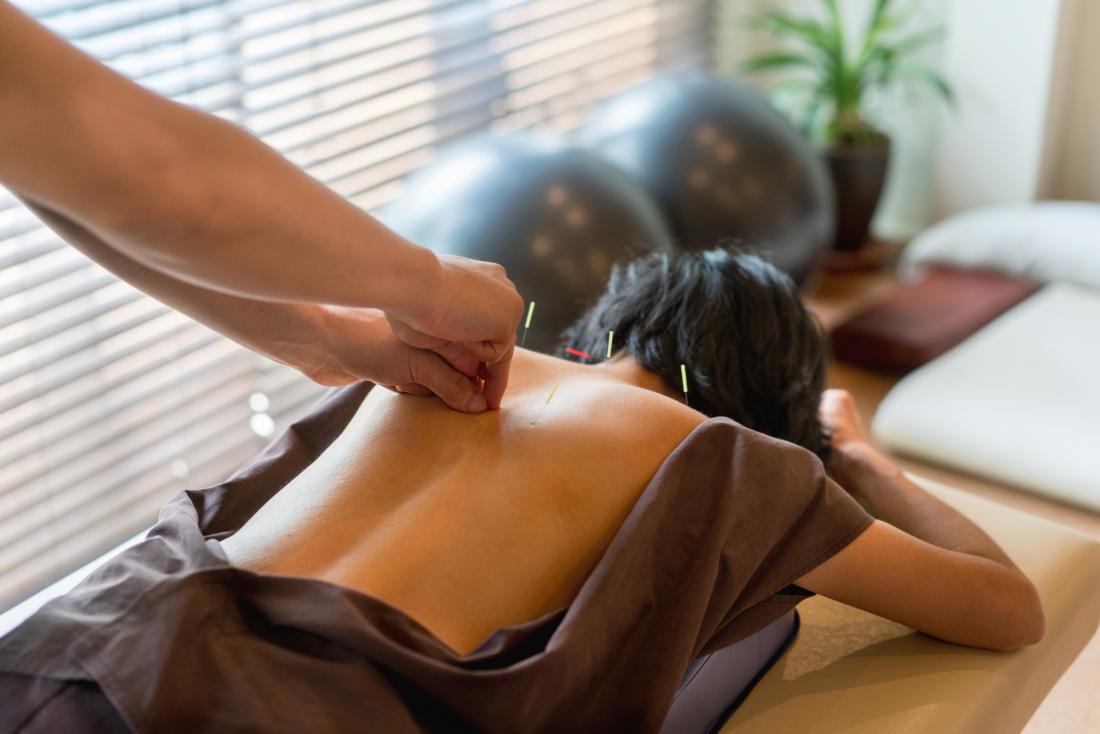 woman having acupuncture