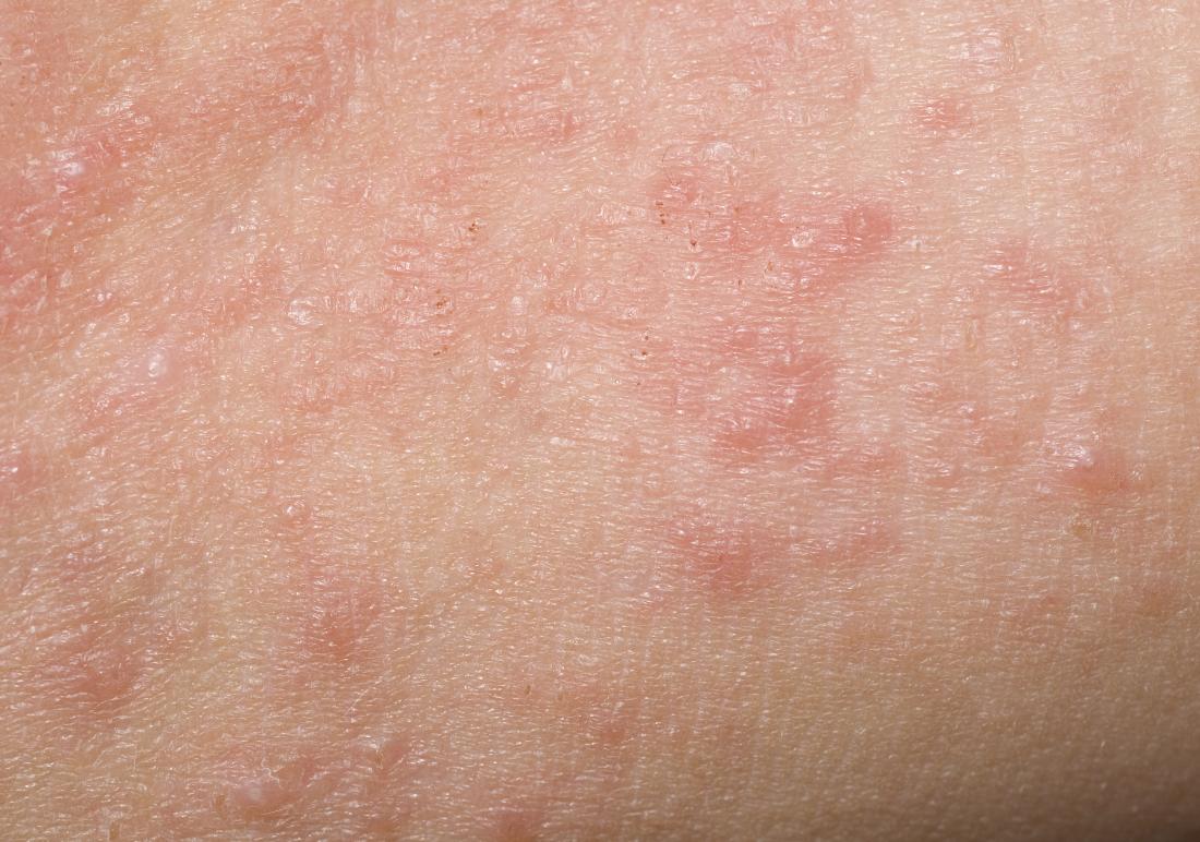 skin rashes that itch