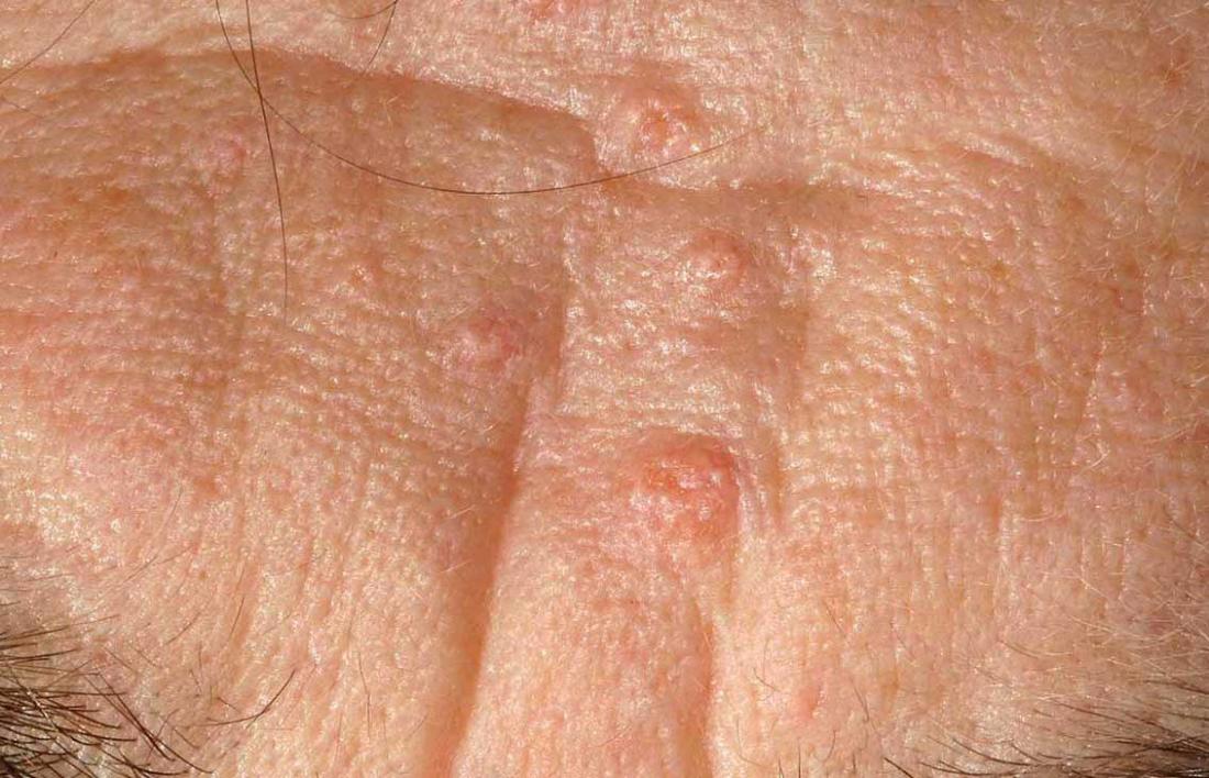 Sebaceous Hyperplasia Causes Symptoms And Removal