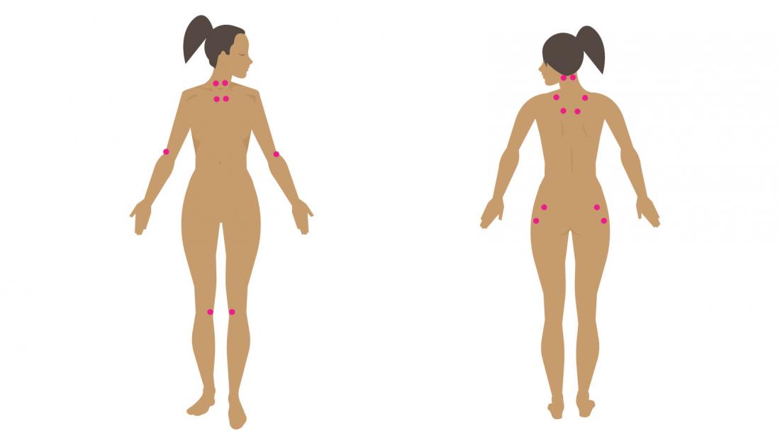 Fibromyalgia Trigger Points Chart