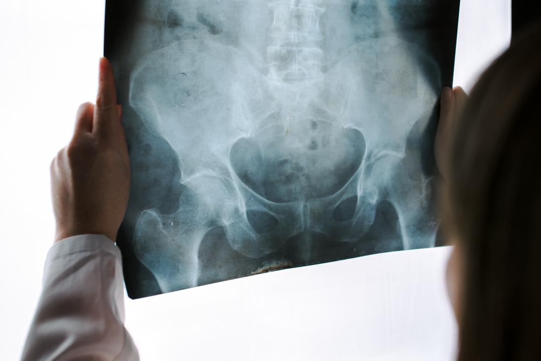 RadioGraphics on X: A groin lump is not uncommon in girls and