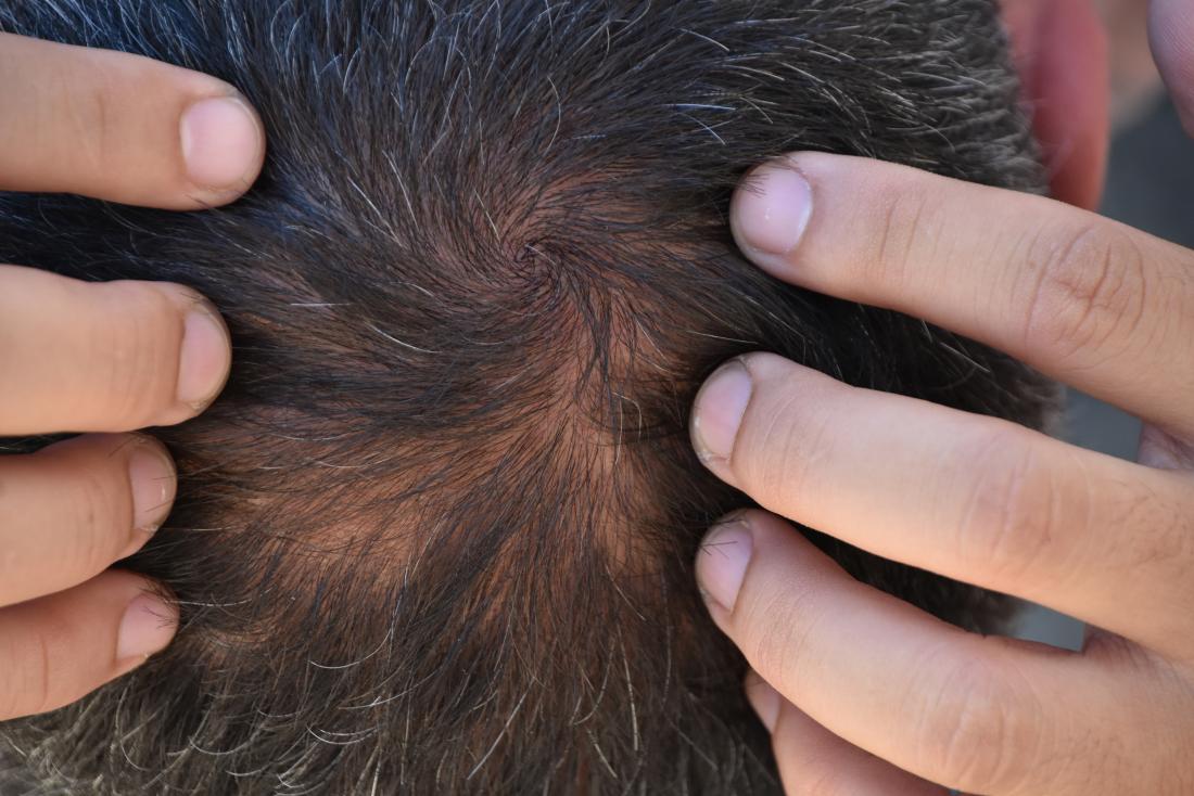 Early Symptoms Of Hair Loss,Hair Fall Symptoms :முடி கொட்ற பிரச்சனை தீவிரமா  இருக்கு என்பதை எப்படி கண்டுபிடிப்பது? அதுக்கு தீர்வு என்ன? - common causes  and symptoms for hair fall ...