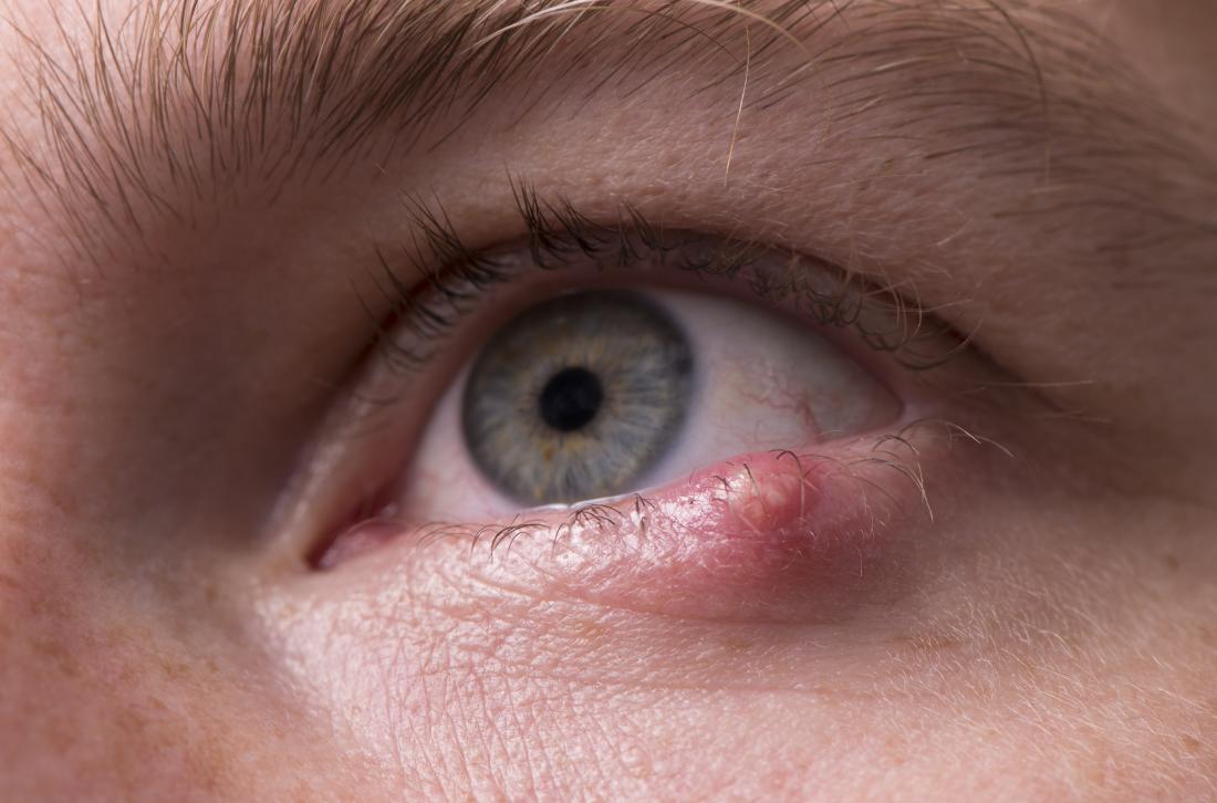 Bumps on eyeball: Causes, types, and treatment