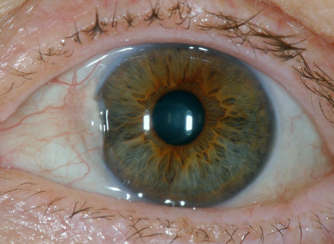 Post Op Sclera Over Iris Part Rstrabismus 