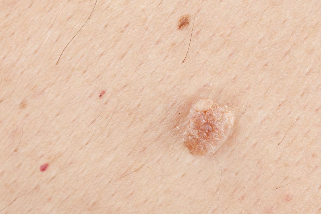 Large Skin Tags All Over Body