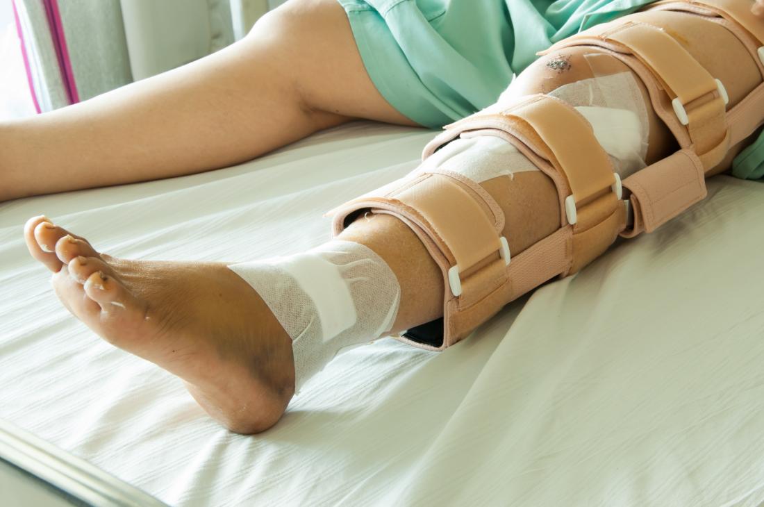 Tibia Fracture Types Symptoms And Treatment