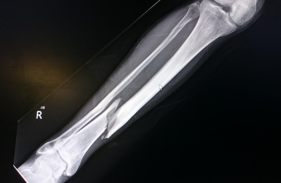 Tibia Fracture After Total Knee Replacement at Herman Dunlap blog