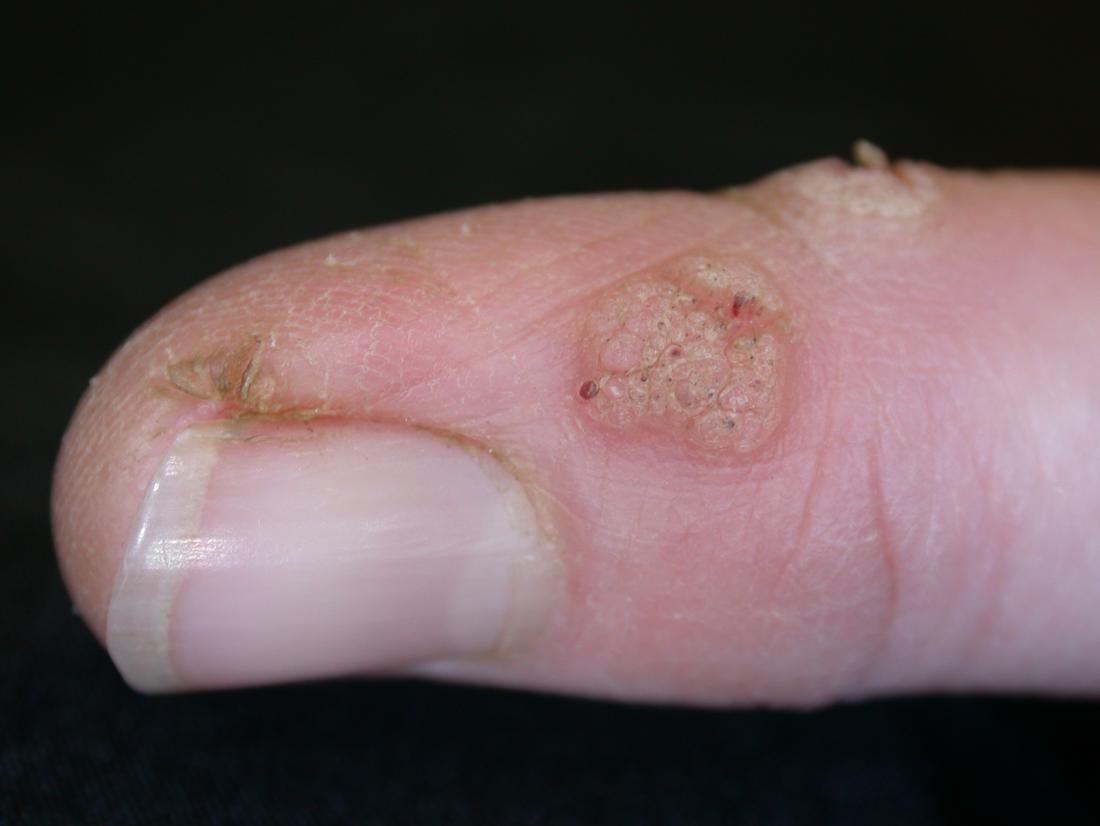 black warts on hands