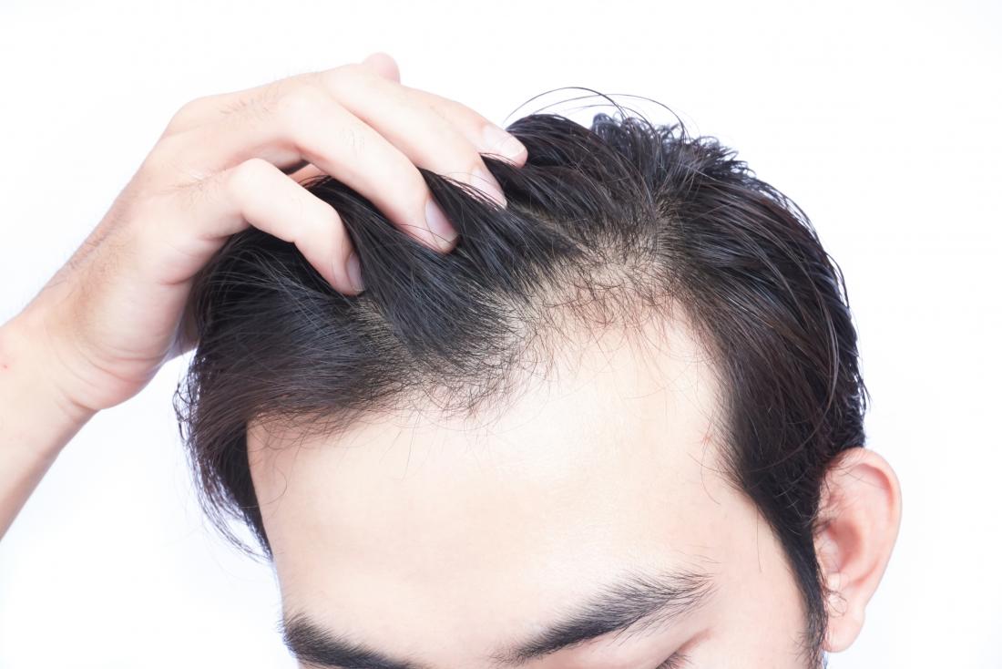 What Causes Hair Loss 10 Common Culprits  GoodRx