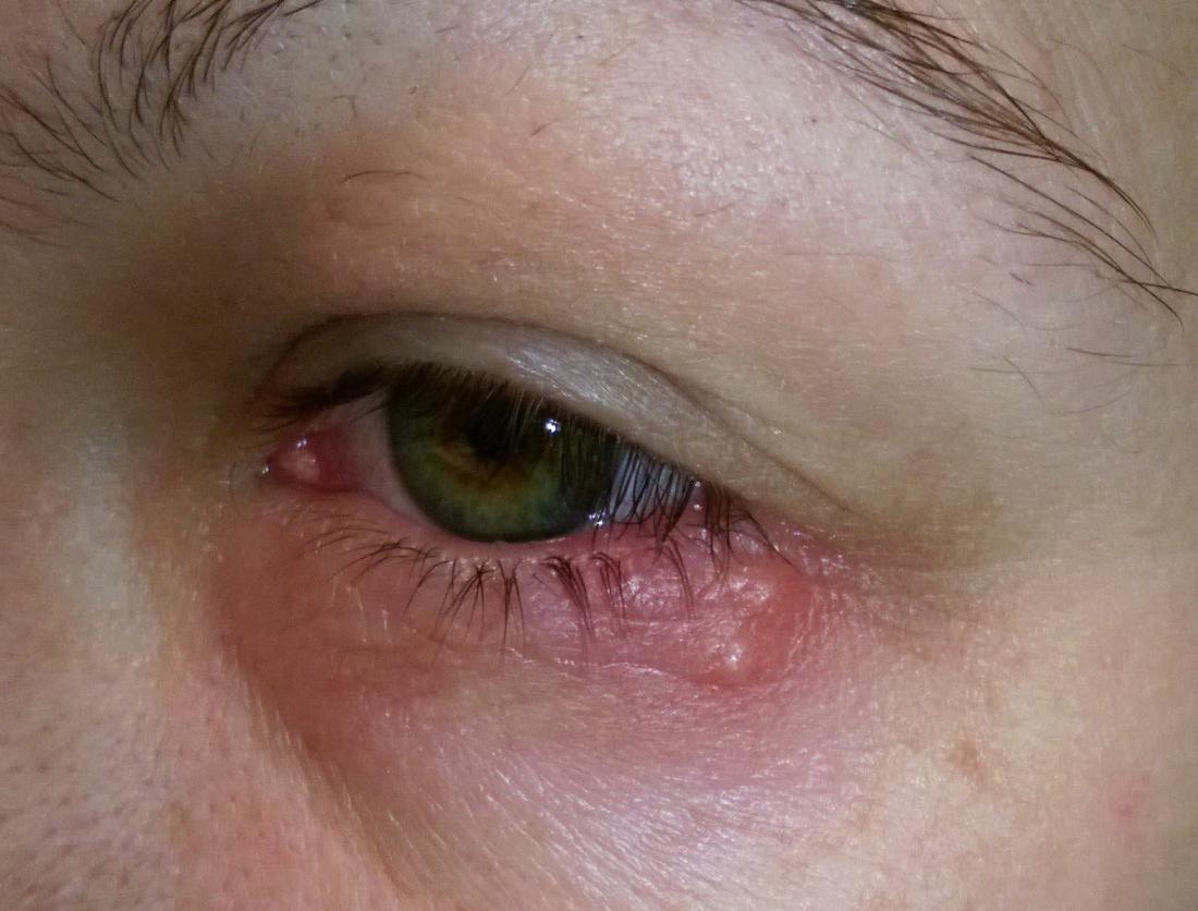 cold sores on eyes