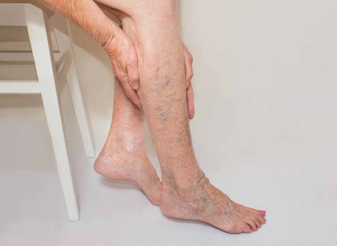 https://cdn-prod.medicalnewstoday.com/content/images/articles/321/321703/varicose-veins-home-treatment.jpg