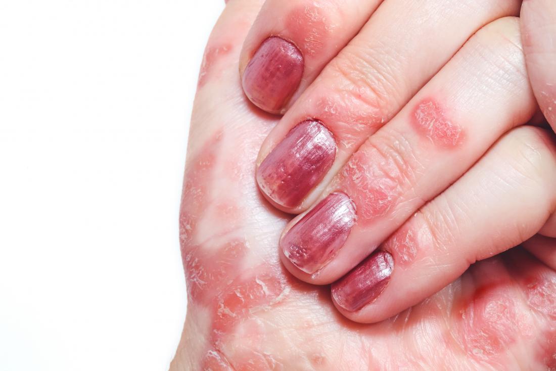 Itchy fingers: Symptoms, causes, and treatment
