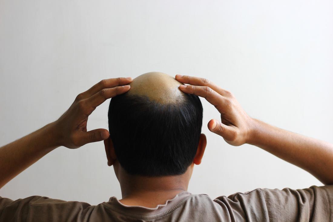 Existing drug may be the answer to hair loss