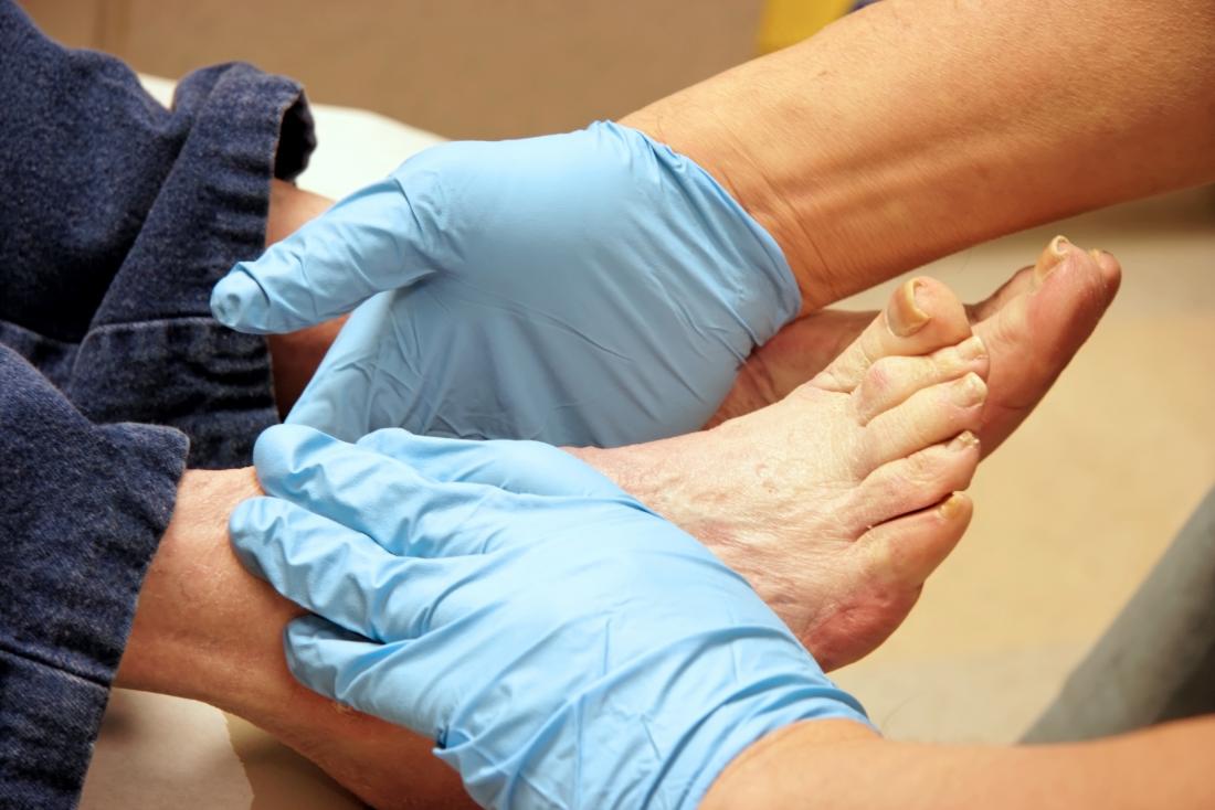 orthotic for plantar fibroma