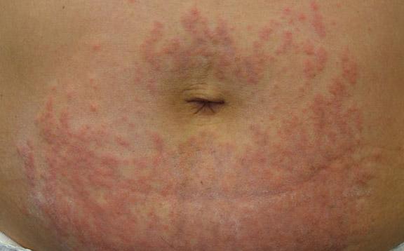 maculopapular rash