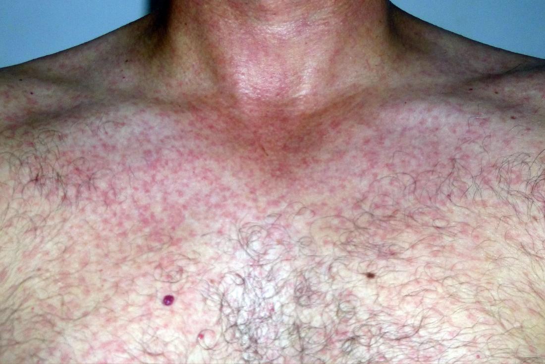Clinical Challenge: Rash on Chest and Extremities - MPR