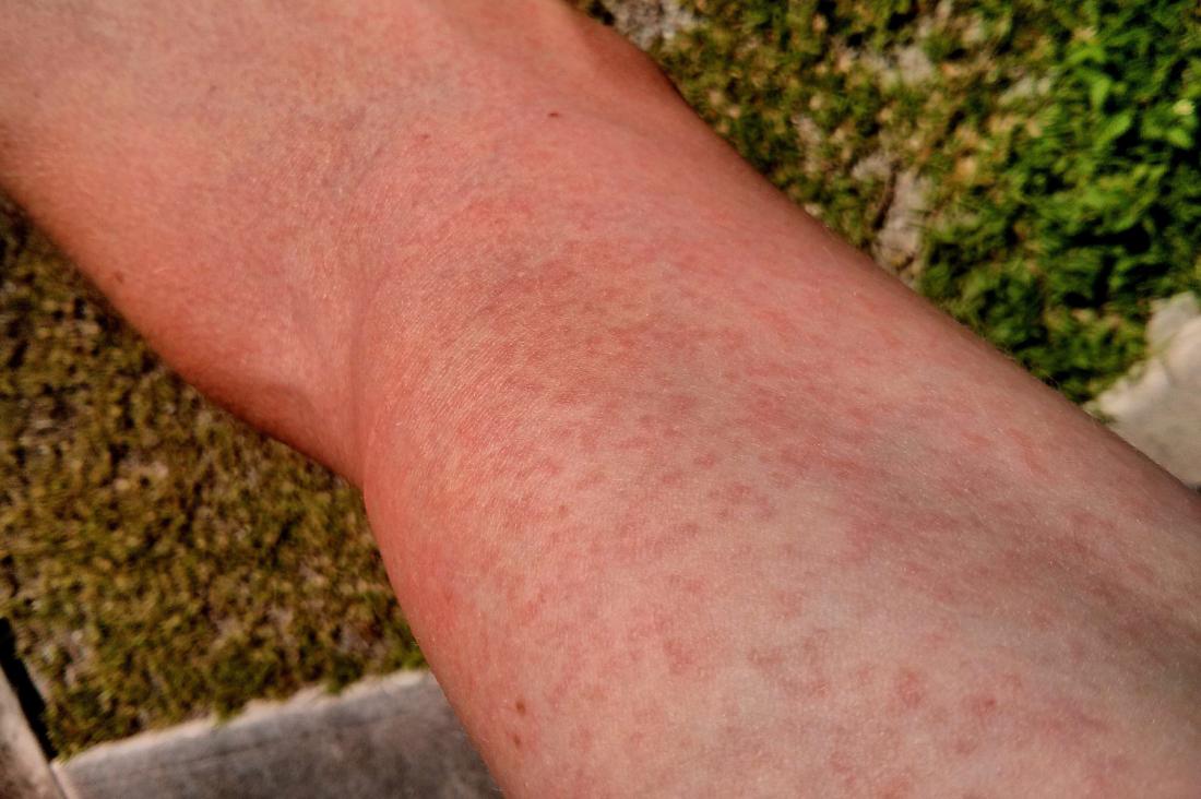 maculopapular rash hands