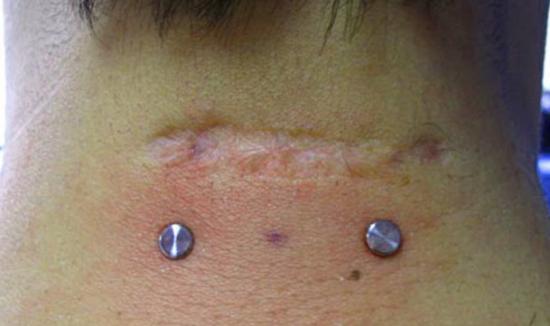 dermal piercing face scar