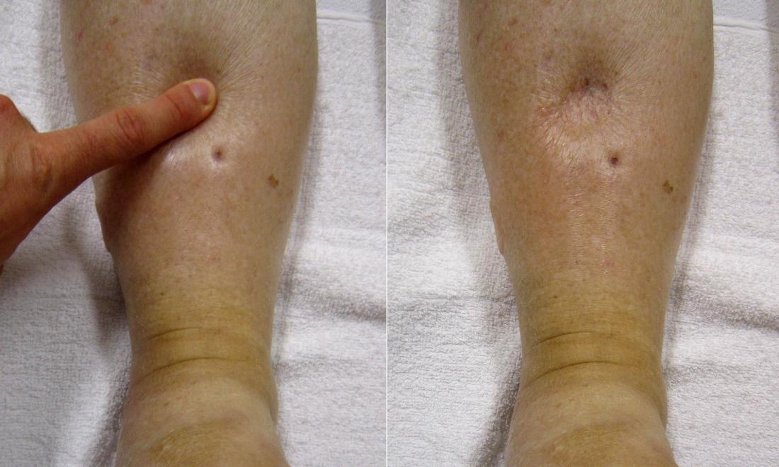 What Causes Pitting Edema In The Left Leg