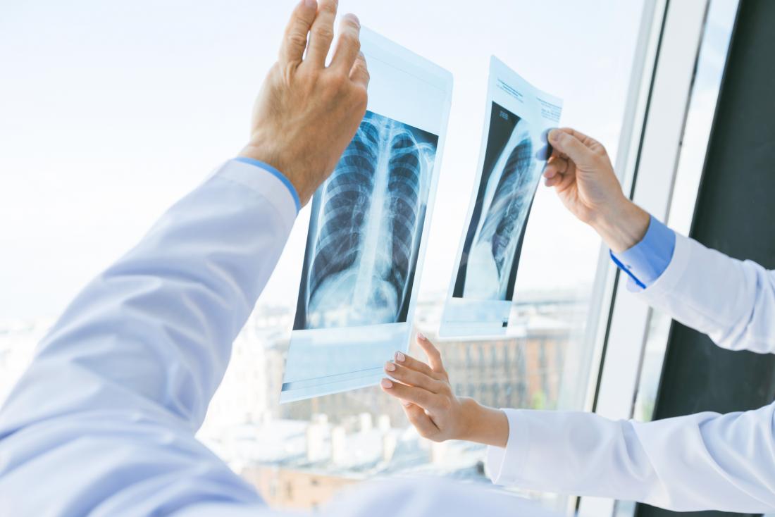 Chest x-ray being looked at by doctors