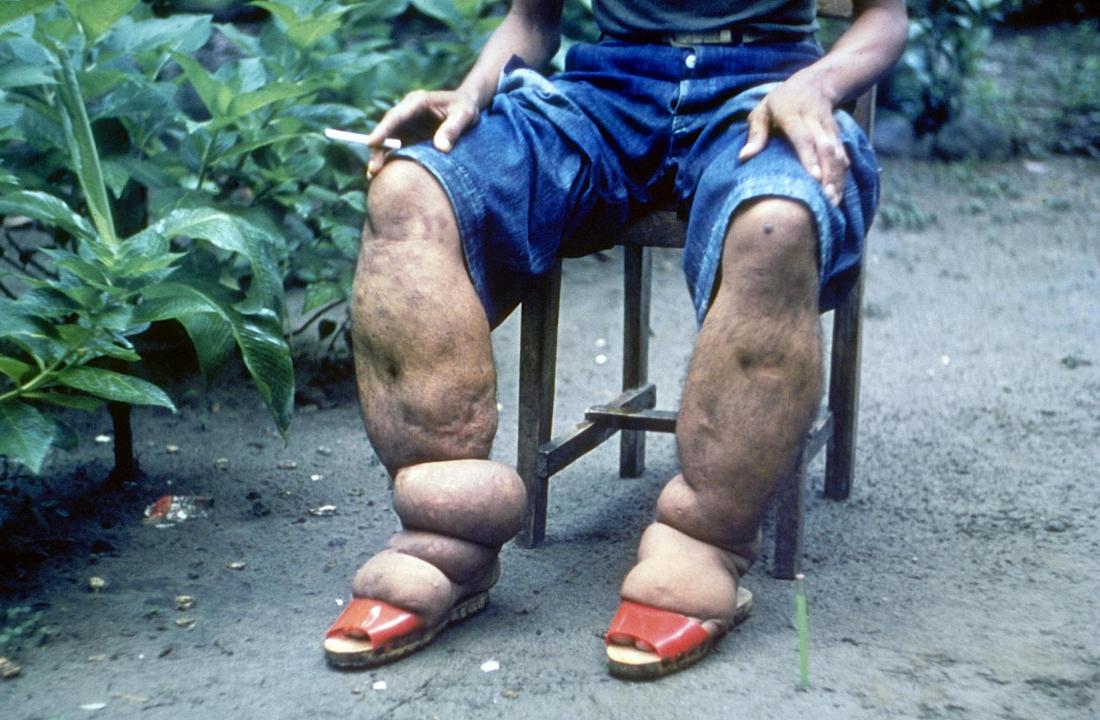 elephantiasis-in-man-s-legs-br-image-credit-cdc-1962-br.jpg