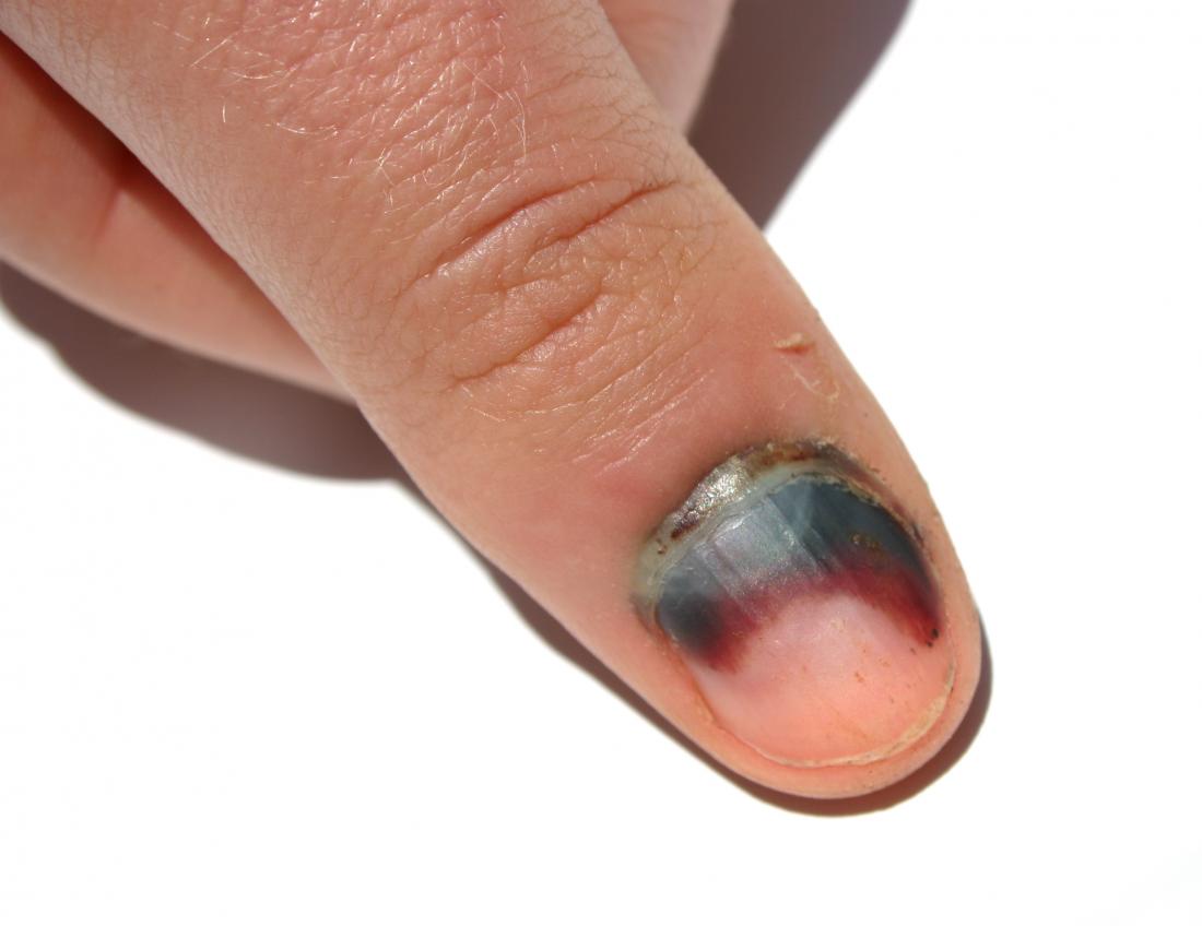 Aggregate 64+ bruise under nail