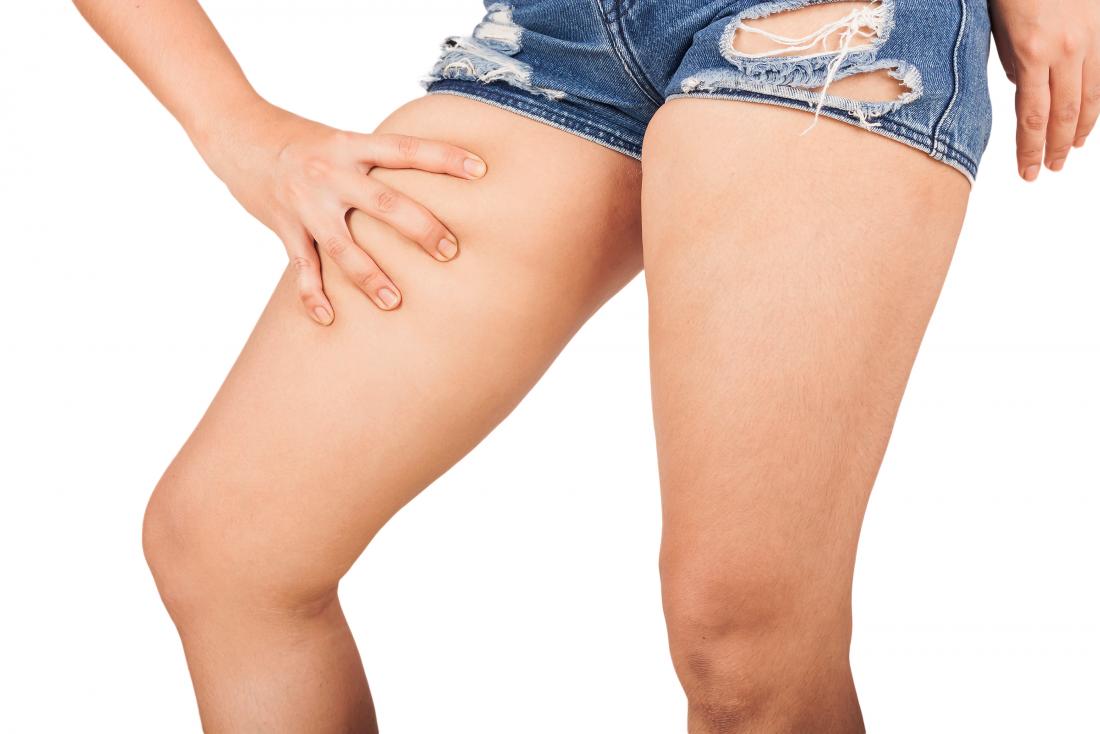 Inner Thigh Chafing: Causes, Symptoms, Treatment, and Prevention