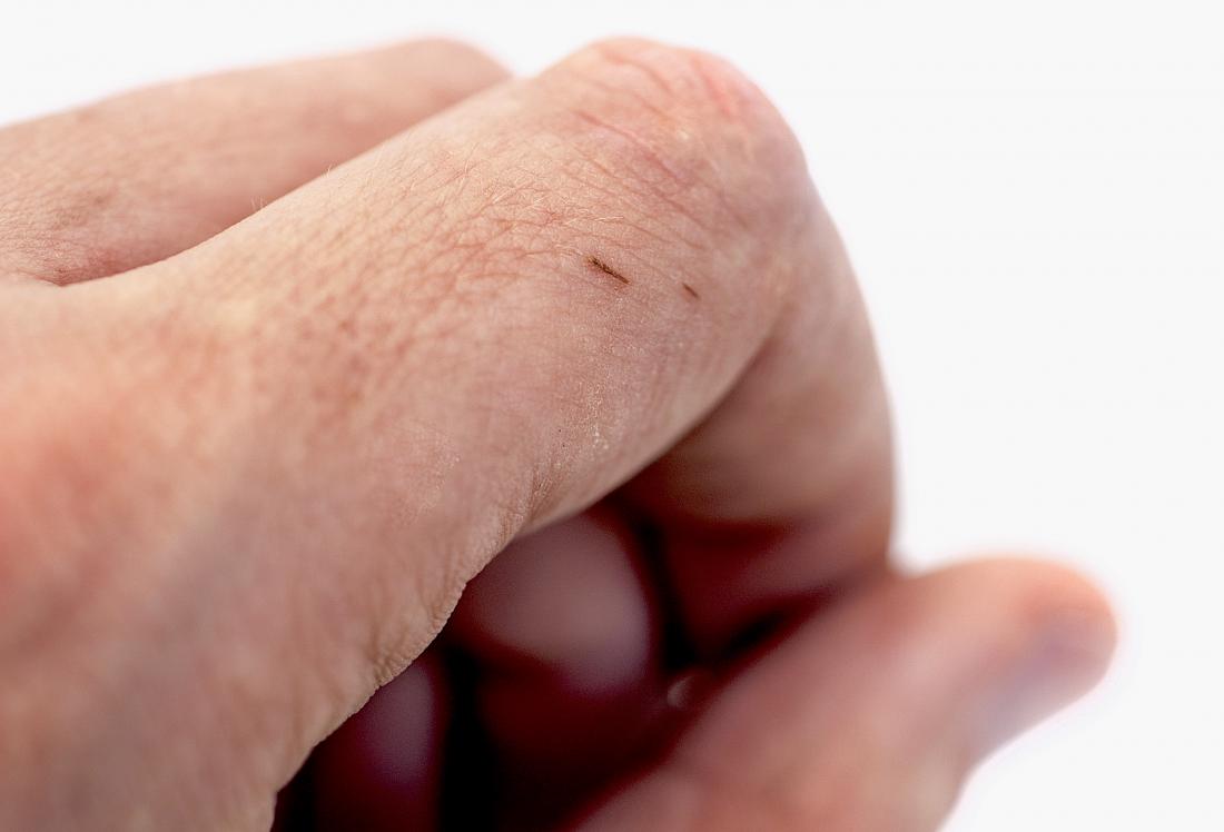 皮膚に破片が出る。