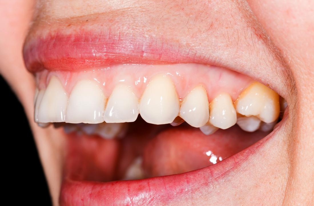 My Gums are White: Uncover the Causes and Solutions Now!