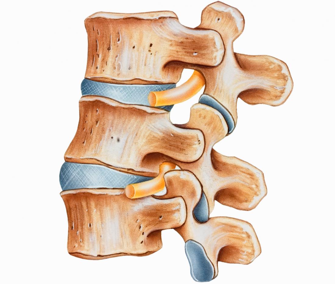 Diagram of hyperlordosis