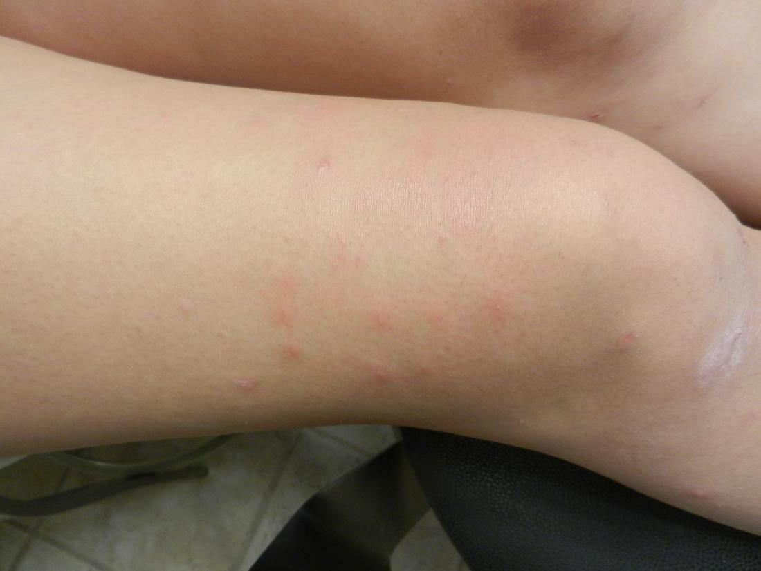 Inficere blad Åben Pimples on legs: Causes and treatment