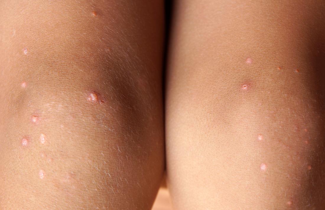 Inficere blad Åben Pimples on legs: Causes and treatment