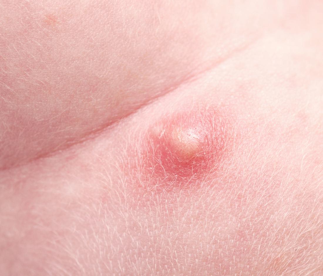 Pimple Lole Break Out In Groin Area