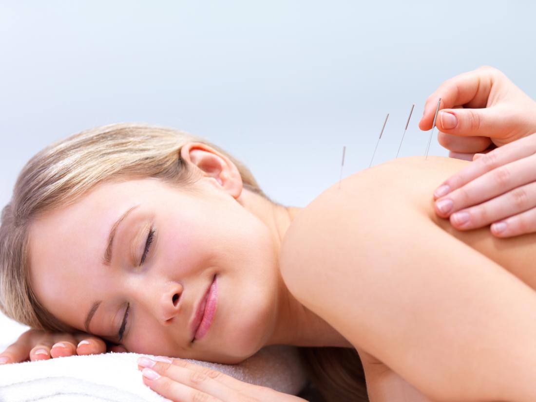 Dry needling vs. acupuncture: Benefits and uses