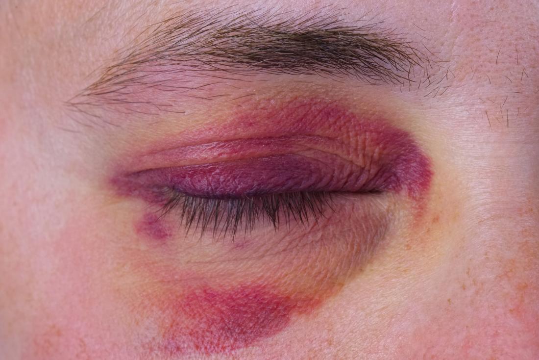 Broken Eye Socket Pictures Causes And Treatment