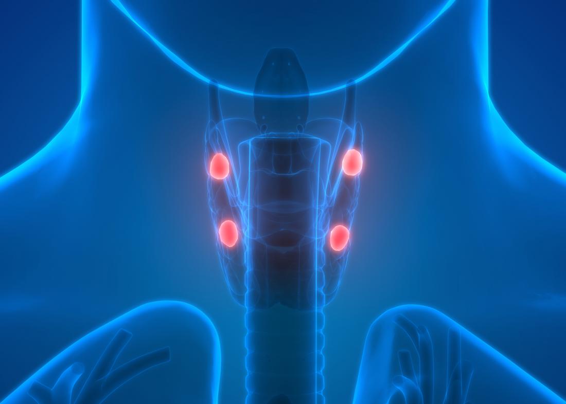 Hypercalcemia: Symptoms, causes, diagnosis, and treatment