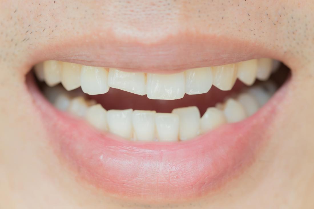 Cracked tooth: Types, causes, and treatments