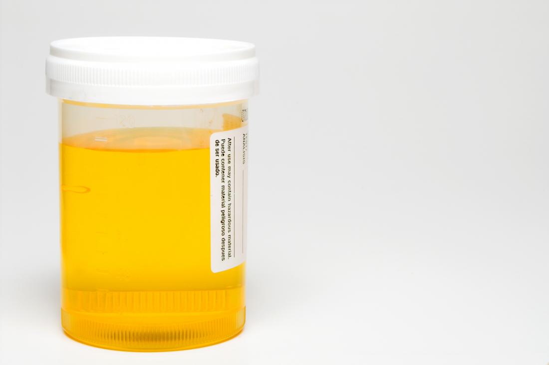 Urine smells like sulfur 11 causes and treatment