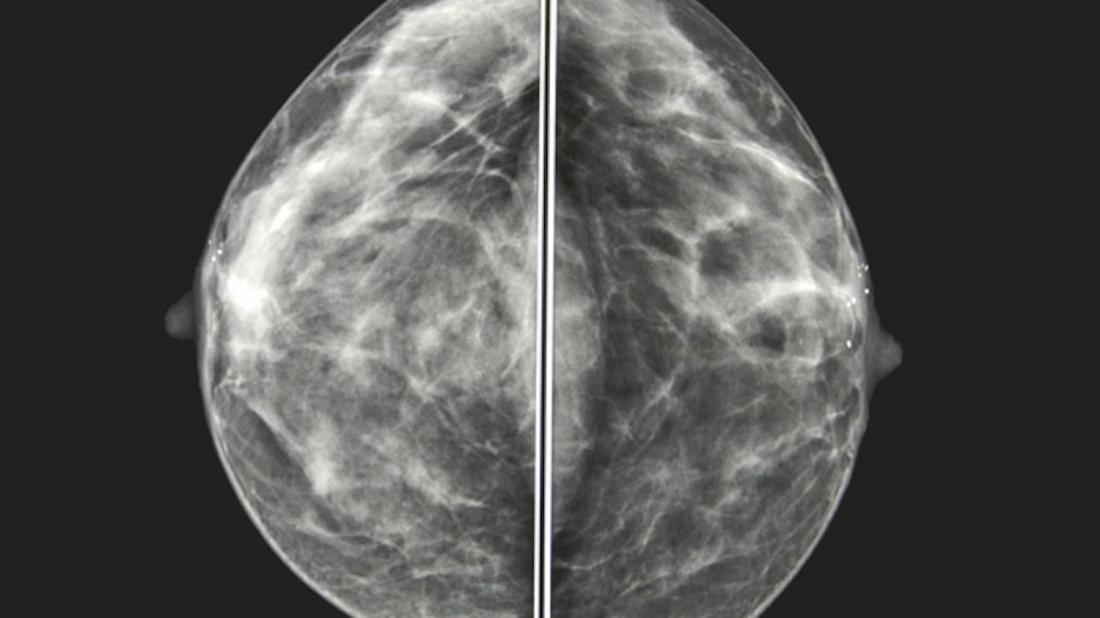 Mammography (Breast Imaging)