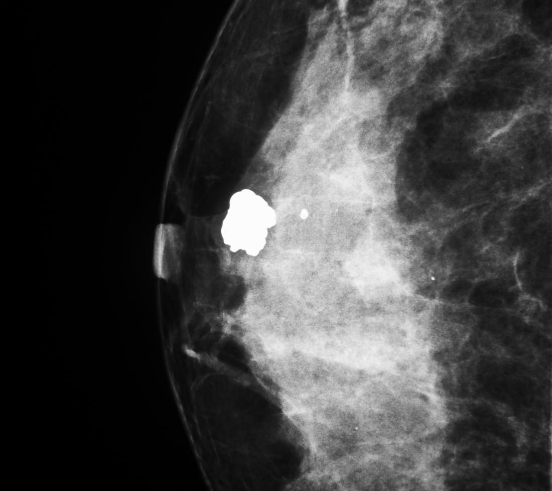 PHOTO GALLERY: What does breast cancer look like on mammography