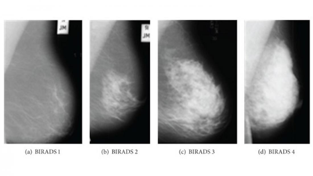 PHOTO GALLERY: What does breast cancer look like on mammography