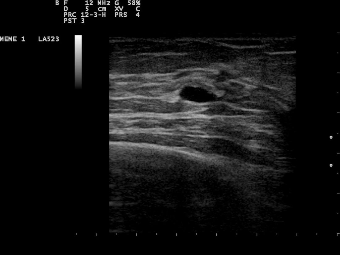 A A Simple Breast Cyst B Breast Ultrasound Showing A Cancer Images